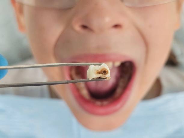 Best Teeth Whitening  in Start, LA
